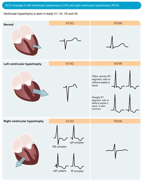 left ventricular hypertrophy by voltage.